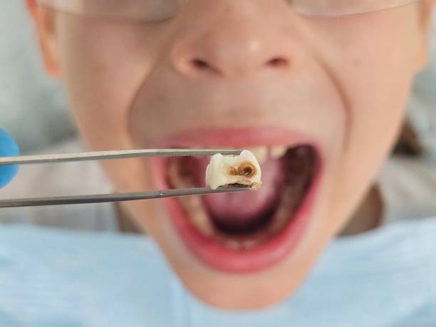 Best Emergency Dental Extractions in Fruitland, MD